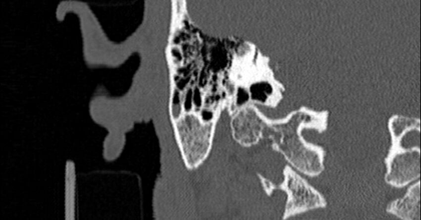 Bilateral temporal bone fractures (Radiopaedia 29482-29970 Coronal non-contrast 136).jpg