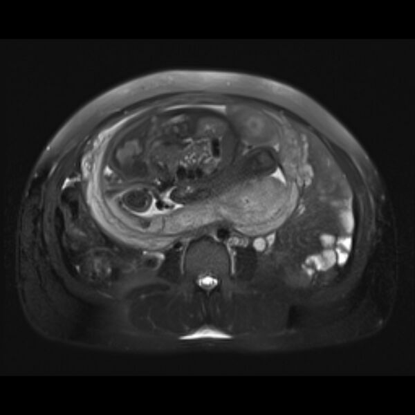 File:Bilobed placenta accreta (Radiopaedia 69648-79591 Axial T2 fat sat 18).jpg