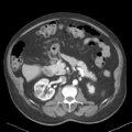 Bladder papillary urothelial carcinoma (Radiopaedia 48119-52951 A 19).png