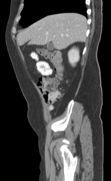 File:Bleeding duodenal ulcer and adenomyomatosis of gallbladder (Radiopaedia 61834-69861 C 19).jpg