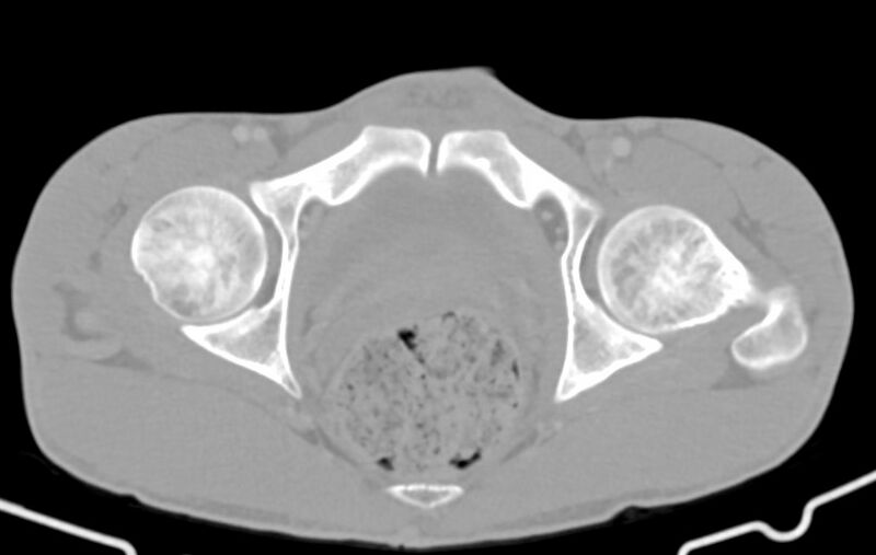 File:Blunt injury to the small bowel (Radiopaedia 74953-85987 Axial Wide 94).jpg