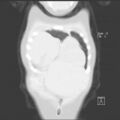 Bochdalek diaphragmatic hernia (Radiopaedia 38866-41059 Coronal lung window 4).jpg