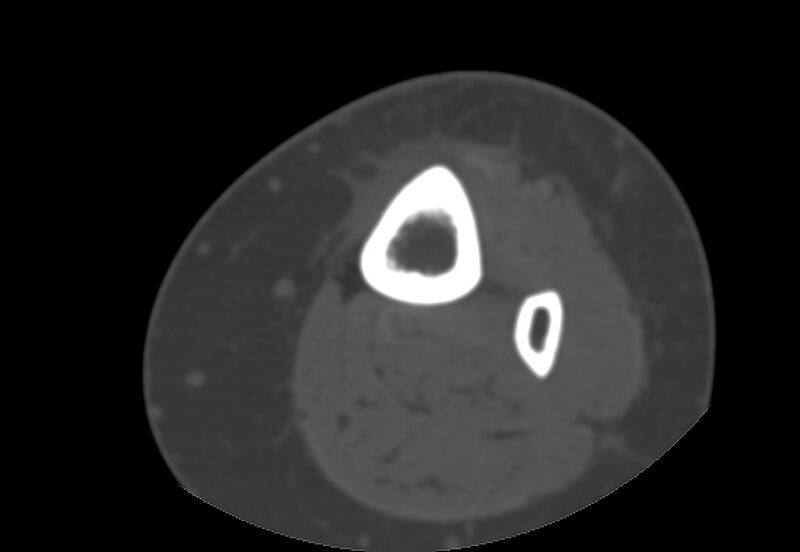 File:Bone metastasis - tibia (Radiopaedia 57665-64609 Axial bone window 9).jpg