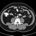 Bosniak cyst - type IV (Radiopaedia 23525-23627 renal cortical phase 48).jpg