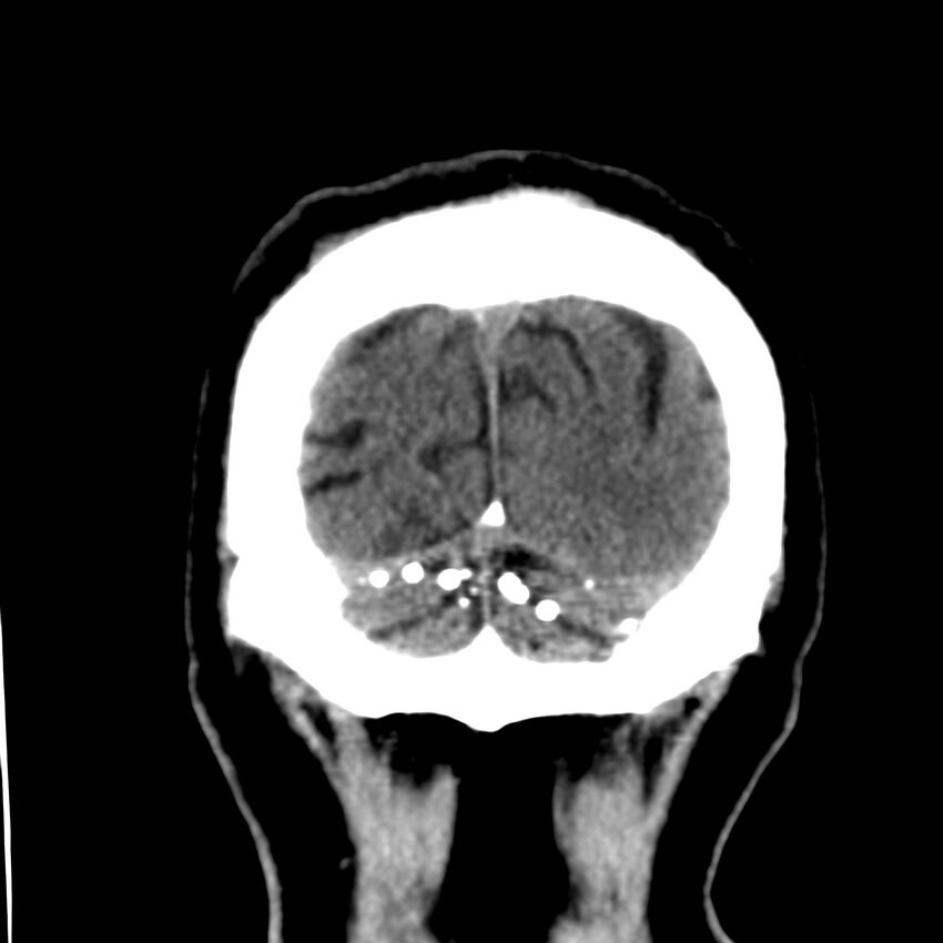 Brain Pantopaque remnants (Radiopaedia 78403-91048 Coronal non-contrast 64).jpg