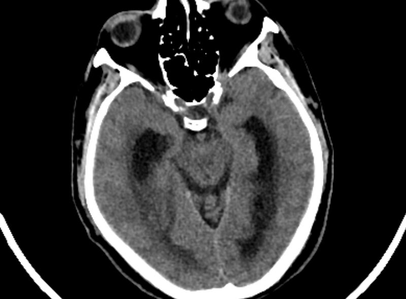 File:Brain abscess complicated by intraventricular rupture and ventriculitis (Radiopaedia 82434-96575 Axial non-contrast 16).jpg