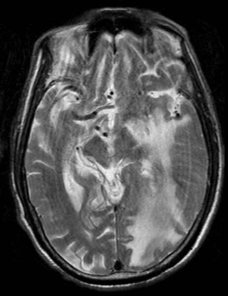 File:Brain abscess with dual rim sign (Radiopaedia 87566-103938 Axial T2 10).jpg