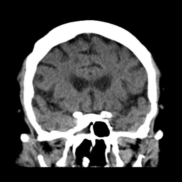 File:Brain cortical laminar necrosis (Radiopaedia 25822-25971 C 20).jpg