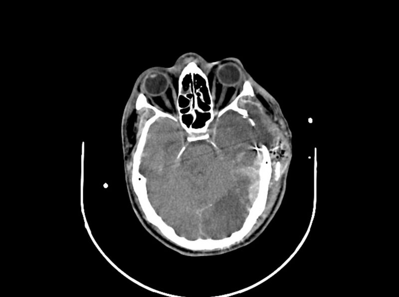 File:Brain injury by firearm projectile (Radiopaedia 82068-96087 B 79).jpg
