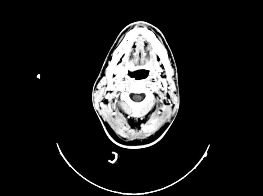 Brain injury by firearm projectile (Radiopaedia 82068-96088 B 34).jpg