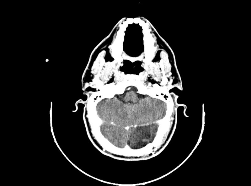 File:Brain injury by firearm projectile (Radiopaedia 82068-96088 B 79).jpg