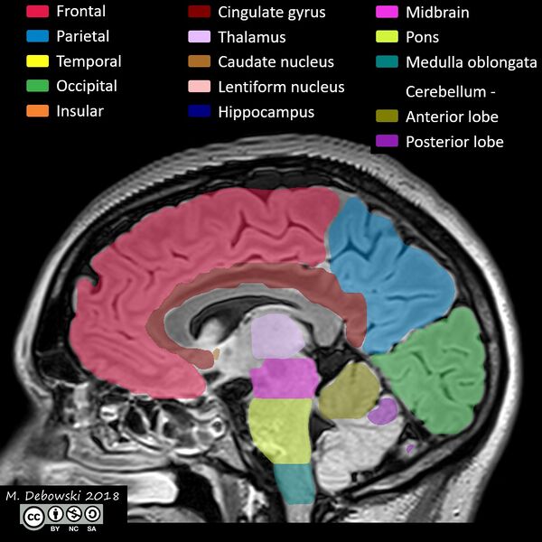 File:Brain lobes - annotated MRI (Radiopaedia 61691-69700 Sagittal 42).JPG