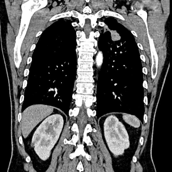 File:Brain metastases - lung cancer primary (Radiopaedia 75060-86116 C+ arterial phase 52).jpg