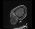 Brainstem glioma (Radiopaedia 21819-21775 D 41).jpg