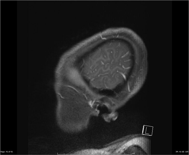 File:Brainstem glioma (Radiopaedia 21819-21775 D 41).jpg