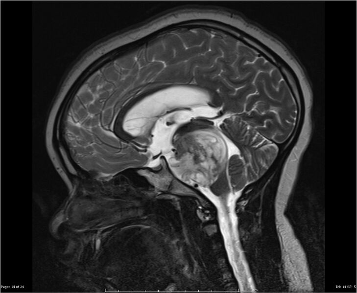 File:Brainstem glioma (Radiopaedia 21819-21775 Sagittal T2 14).jpg