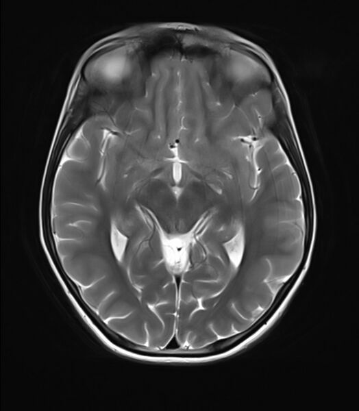 File:Brainstem glioma (Radiopaedia 70548-80674 Axial T2 12).jpg