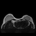 Breast implants - MRI (Radiopaedia 26864-27035 Axial T2 12).jpg