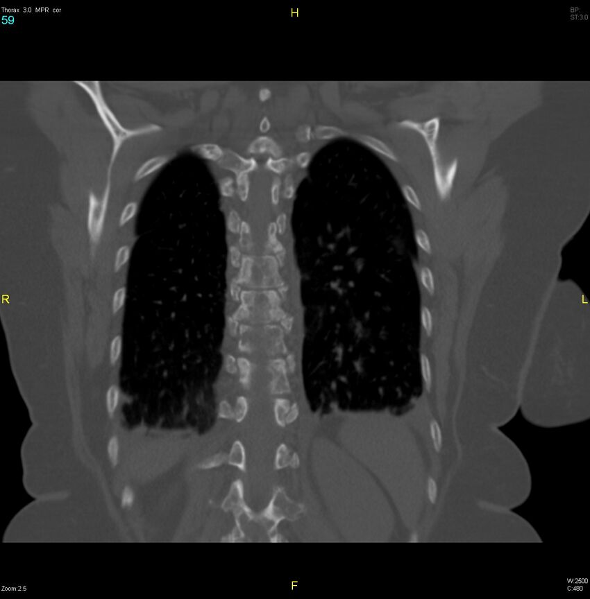 Breast primary with lung and bone metastases (Radiopaedia 40620-43228 bone window 59).jpg