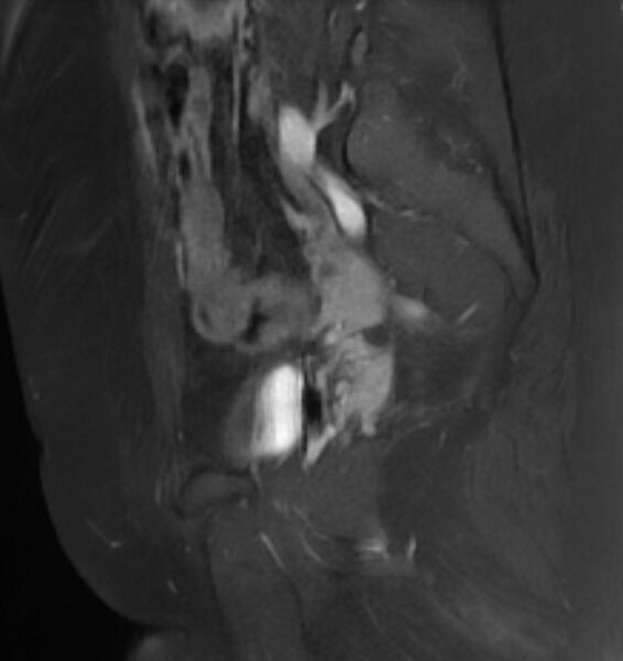 File:Broad ligament leiomyoma (Radiopaedia 81634-95516 G 21).jpg