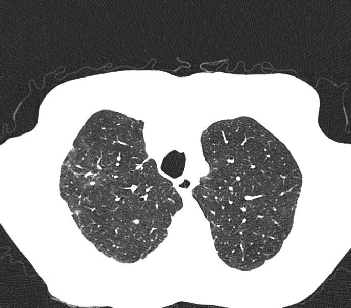 File:Bronchiolitis (Radiopaedia 24616-24887 Axial lung window 8).jpg