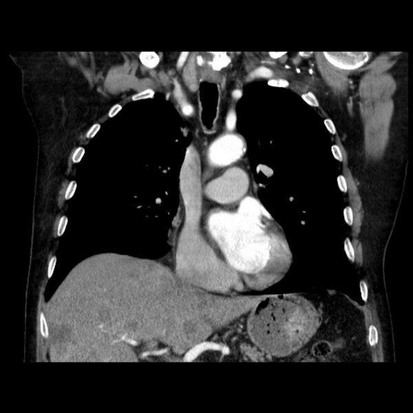 File:Bronchogenic adenocarcinoma and pulmonary embolism (Radiopaedia 9097-9806 C 22).jpg