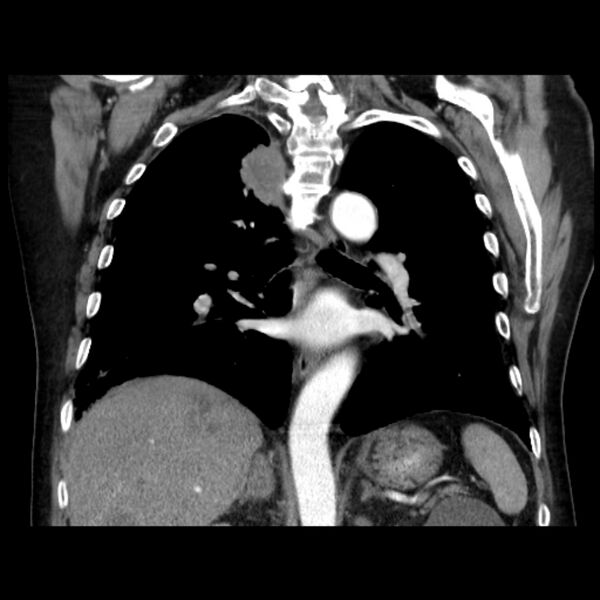File:Bronchogenic adenocarcinoma and pulmonary embolism (Radiopaedia 9097-9806 C 31).jpg