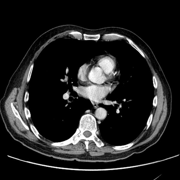 File:Bronchogenic carcinoma with L1 vertebra metastasis (Radiopaedia 9096-9805 Axial C+ delayed 19).jpg