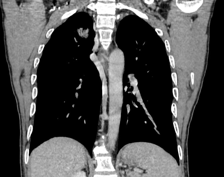 File:Bronchogenic carcinoma with superior vena cava syndrome (Radiopaedia 36497-38054 Coronal C+ delayed 75).jpg
