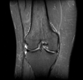 Bucket handle tear - medial meniscus (Radiopaedia 24900-25163 Coronal T2 fat sat 4).png