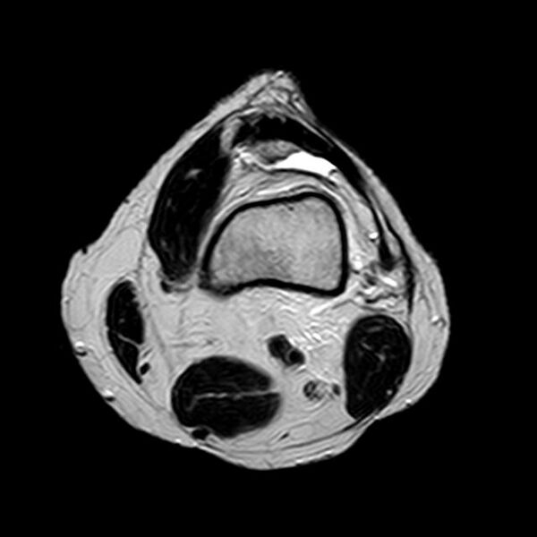 File:Bucket handle tear - medial meniscus (Radiopaedia 29250-29664 Axial T2 17).jpg
