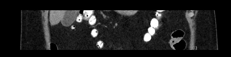 File:Buried bumper syndrome - gastrostomy tube (Radiopaedia 63843-72575 Coronal 29).jpg