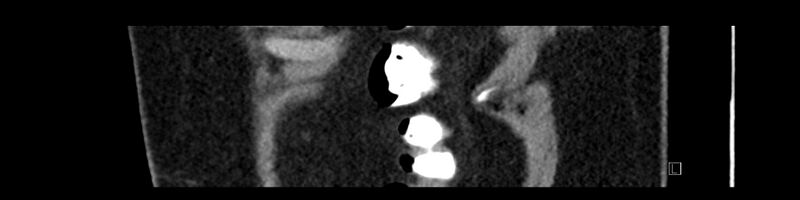 File:Buried bumper syndrome - gastrostomy tube (Radiopaedia 63843-72575 Sagittal Inject 11).jpg