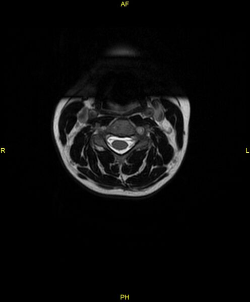 File:C5 nerve sheath tumor (Radiopaedia 85777-101596 Axial T2 17).jpg