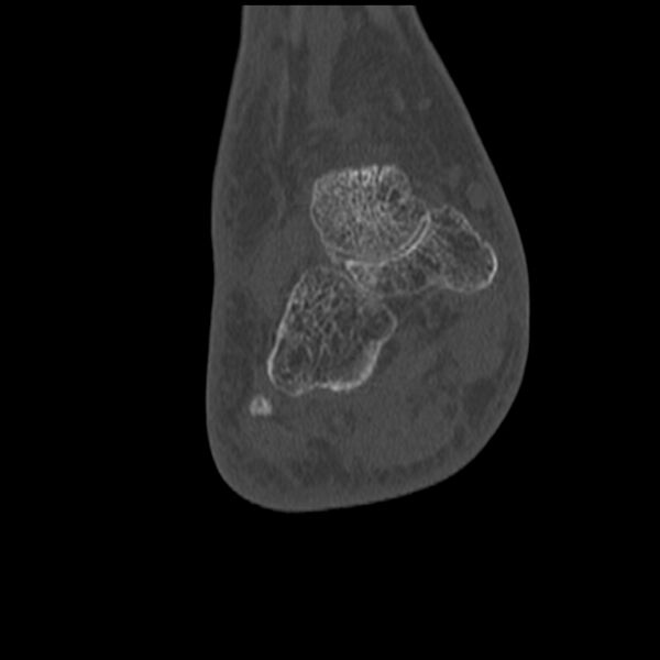 File:Calcaneal tuberosity avulsion fracture (Radiopaedia 22649-22668 Coronal bone window 43).jpg