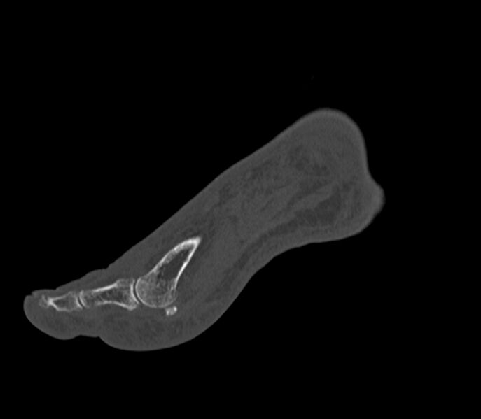 File:Calcaneal tuberosity avulsion fracture (Radiopaedia 22649-22668 Sagittal bone window 44).jpg