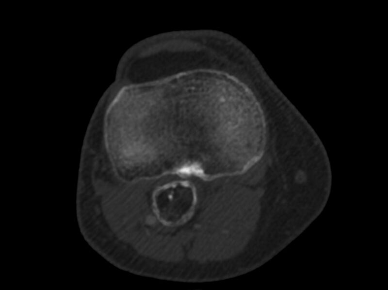 File:Calcified hematoma - popliteal fossa (Radiopaedia 63938-72763 C 40).jpg