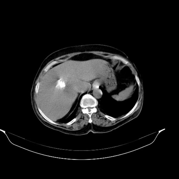 File:Calcified hydatid cyst (Radiopaedia 62000-70085 Axial non-contrast 27).jpg