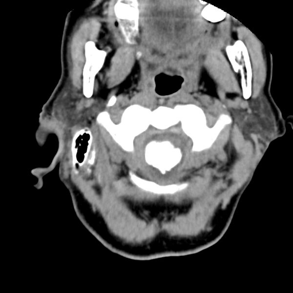 File:Calcified meningioma - cervical canal (Radiopaedia 70136-80171 B 5).jpg