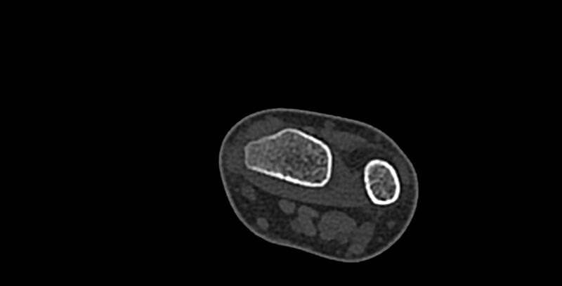 File:Calcifying aponeurotic fibroma (Radiopaedia 88423-105064 Axial bone window 6).jpg