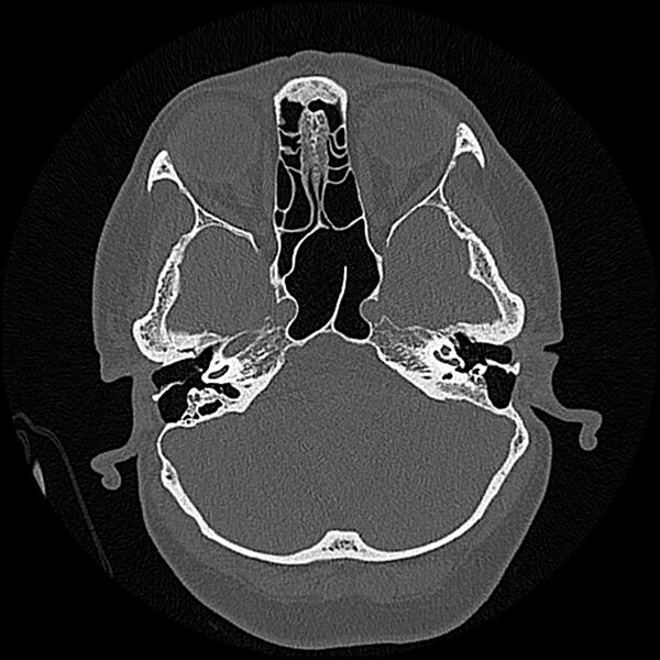 File:Canal up mastoidectomy (Radiopaedia 78108-90638 Axial bone window 66).jpg