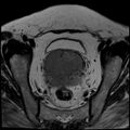 Cancer cervix - stage IIb (Radiopaedia 75411-86615 Axial T2 18).jpg