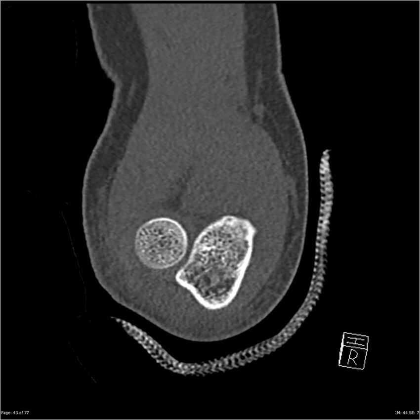 Capitellum fracture (Radiopaedia 23352-23426 Coronal bone window 43).jpg