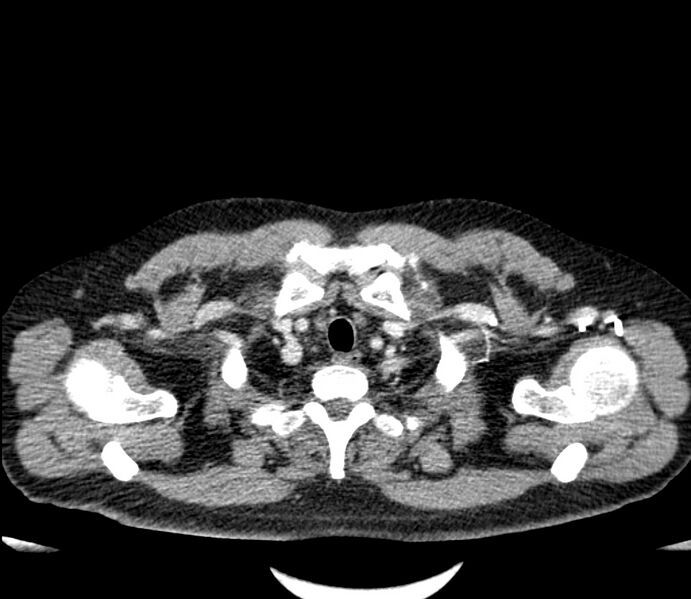 File:Carcinoid tumor with hepatic metastases (Radiopaedia 22651-22670 C 3).jpg