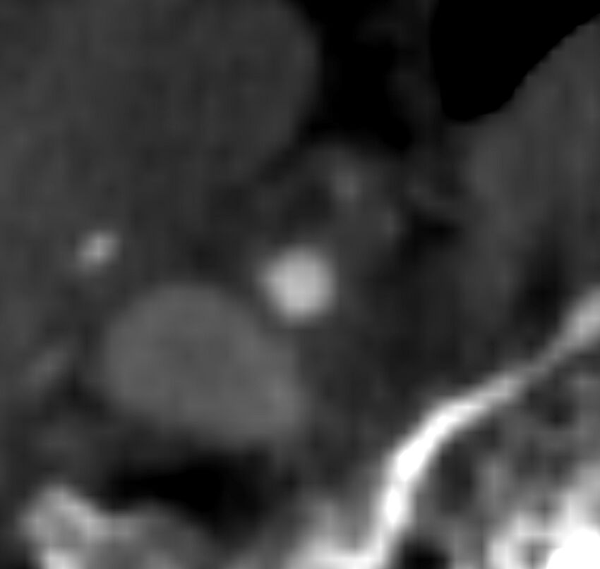 Carotid near-occlusion (Radiopaedia 85304-100887 M 140).jpg