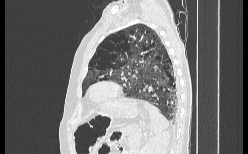 File:Cavitating bronchogenic carcinoma (Radiopaedia 44489-48162 Sagittal lung window 50).jpg
