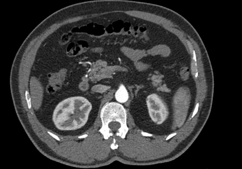 File:Celiac artery dissection (Radiopaedia 52194-58080 A 35).jpg