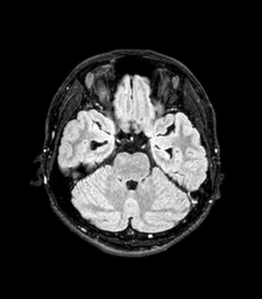 Central neurocytoma (Radiopaedia 79320-92380 Axial FLAIR 210).jpg