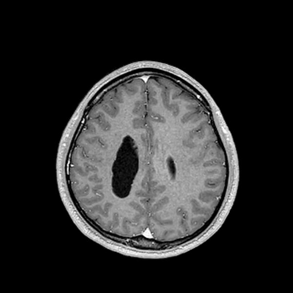 File:Central neurocytoma (Radiopaedia 79320-92380 Axial T1 C+ 171).jpg
