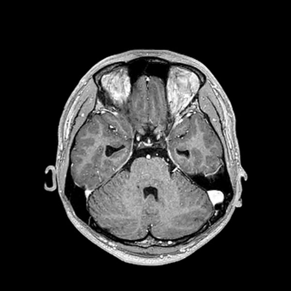 File:Central neurocytoma (Radiopaedia 79320-92380 Axial T1 C+ 89).jpg